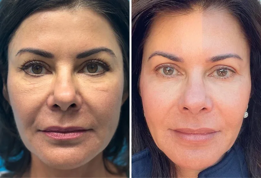 Attiva skin tightening before and after, face, front view, patient 6
