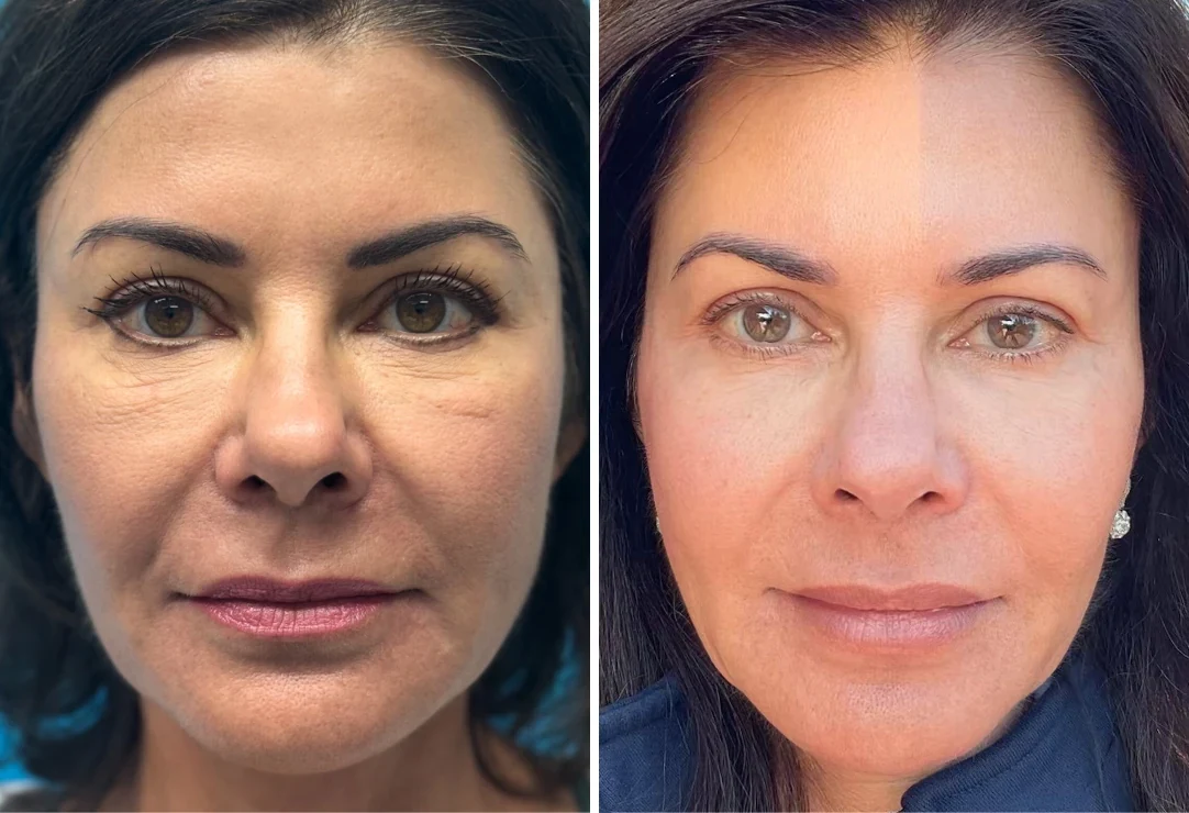 Attiva skin tightening before and after, face, front view, patient 6, enlarged
