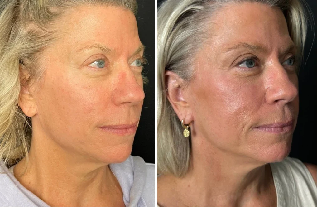 Attiva skin tightening before and after, cheek and jawline, three-quarter view, patient 7, enlarged