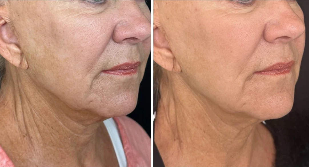 Attiva skin tightening before and after, jowls and neck, close-up side view, patient 8, enlarged