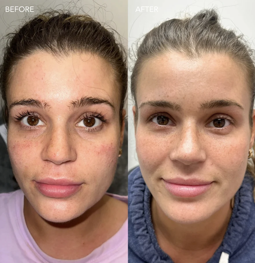 BBL Photofacial before and after results, full face, front view, patient 2