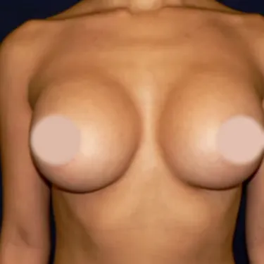 Breast Augmentation after, front view