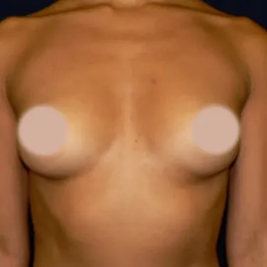 Breast Augmentation before, front view
