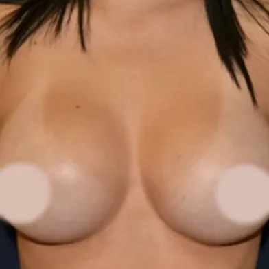 Breast Augmentation after, front view