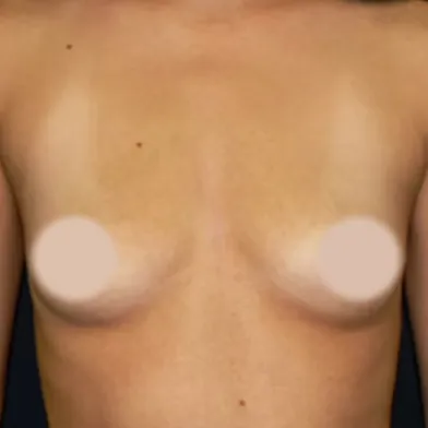 Breast Augmentation before, front view