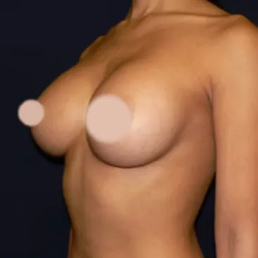 Breast Augmentation after, oblique view