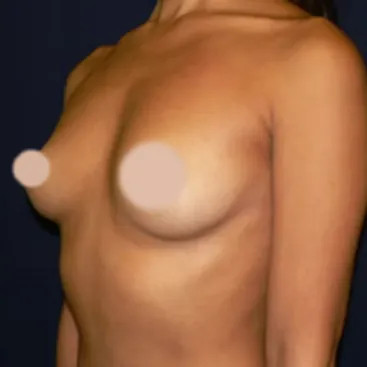 Breast Augmentation before, oblique view