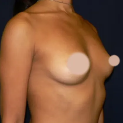 Breast Augmentation before, oblique view