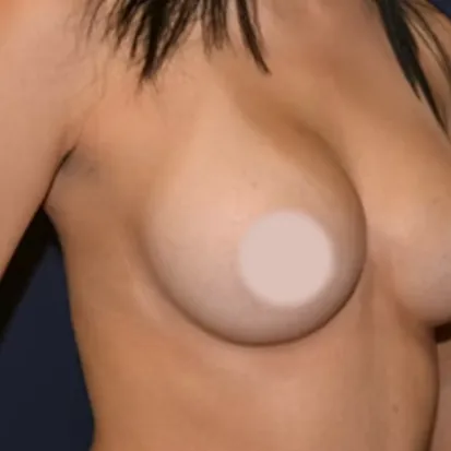 Breast Augmentation after, oblique view