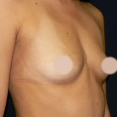 Breast Augmentation before, oblique view