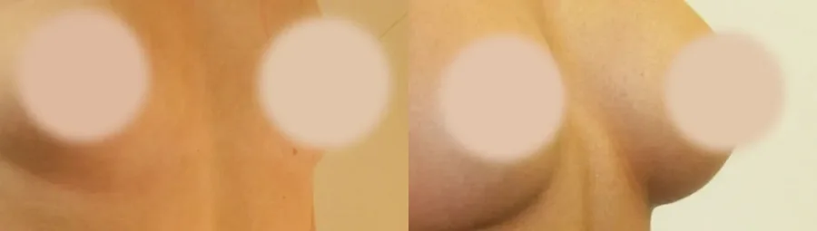 Breast Augmentation before and after, oblique view