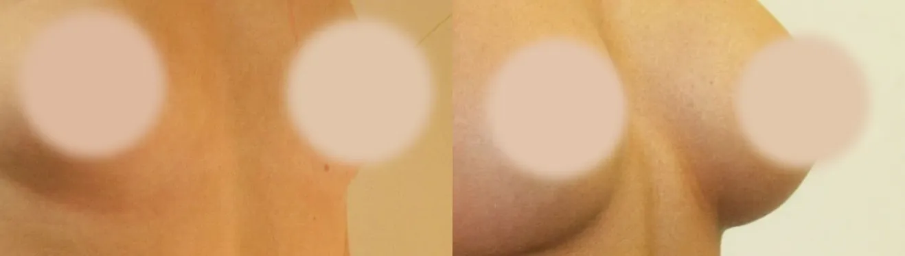 Breast Augmentation before and after, oblique view