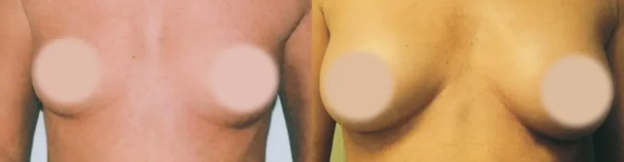 Breast Augmentation before and after, front view