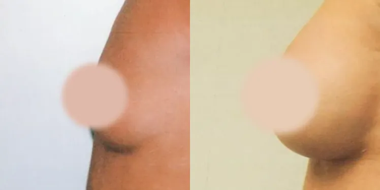 Breast Augmentation before and after, side view