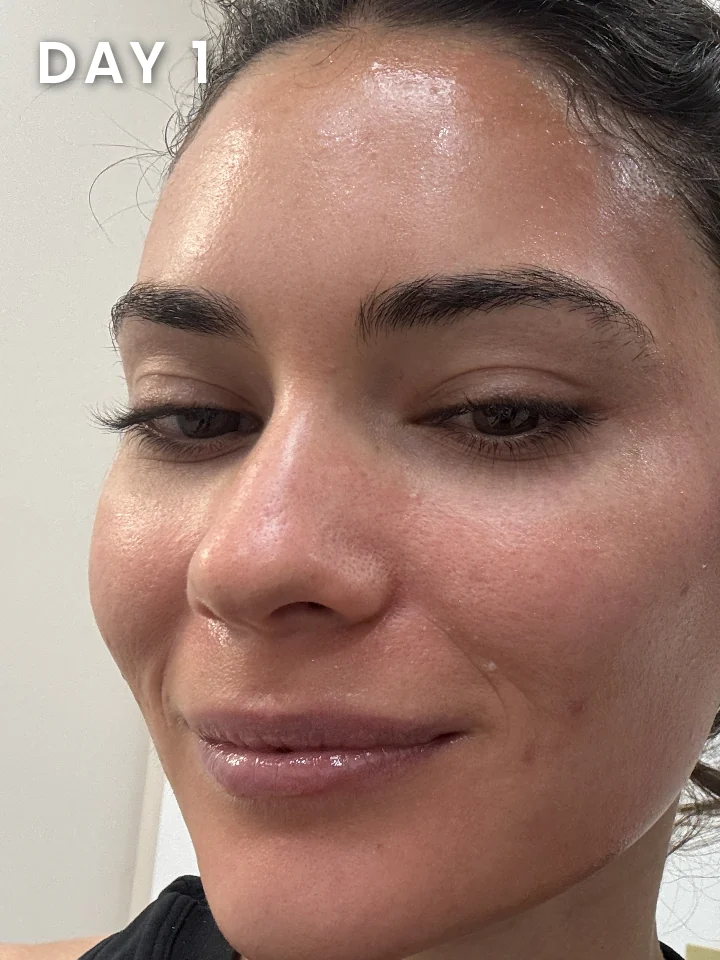 Chemical peel healing progress, day 1