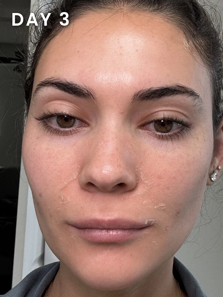Chemical peel healing progress, day 3