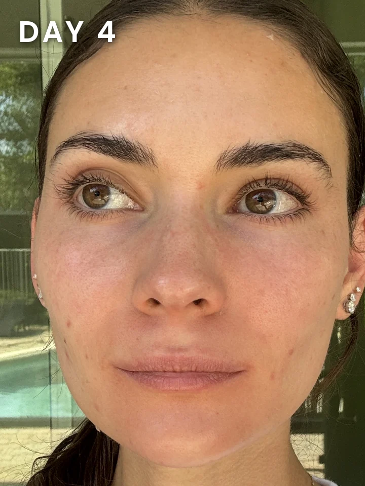 Chemical peel healing progress, day 4