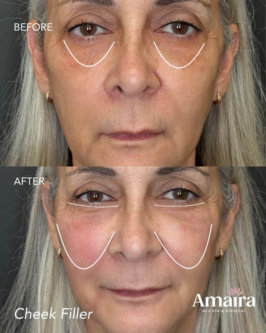 Dermal filler before and after results, cheek filler, front view, patient 5, enlarged