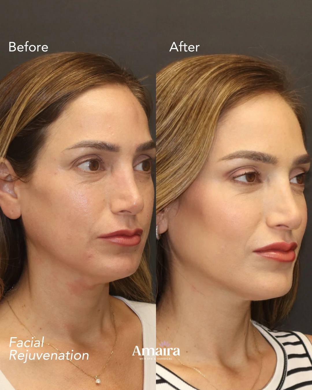 Dermal filler before and after results, facial rejuvenation, three-quarter view, patient 3, enlarged