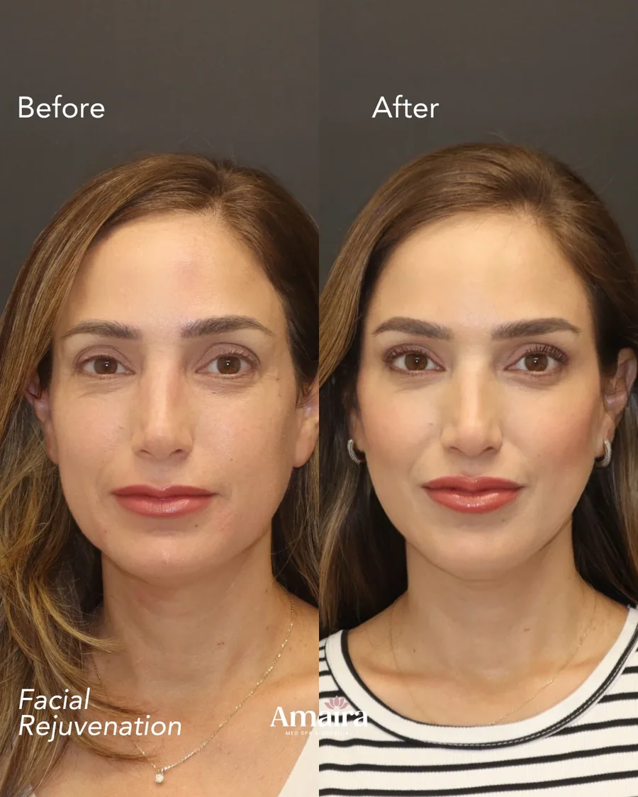 Dermal filler before and after results, facial rejuvenation, front view, patient 3