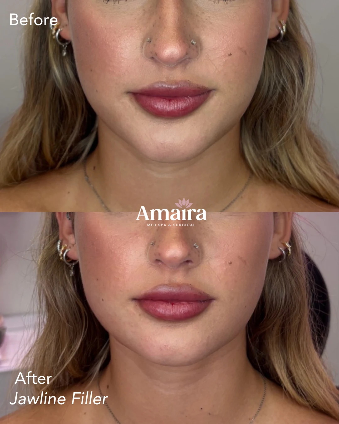 Dermal filler before and after, jawline filler, lips and chin, front view, patient 2, enlarged