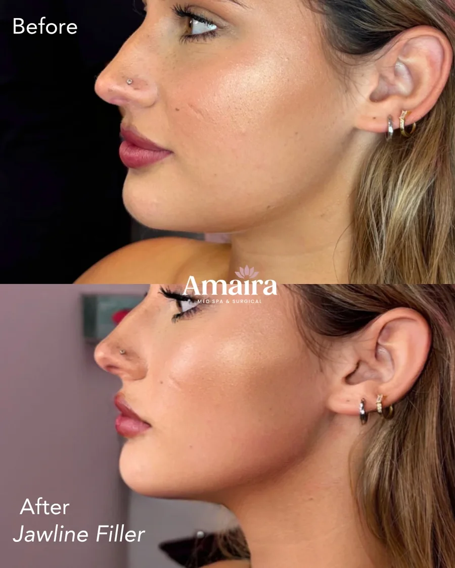 Dermal filler before and after, jawline filler, left side profile, patient 2