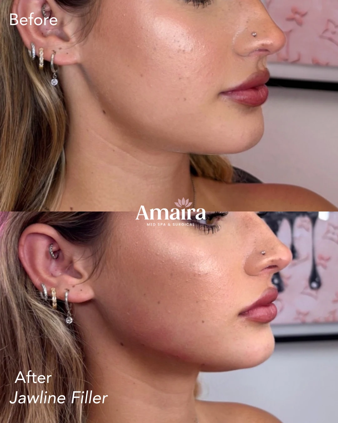 Dermal filler before and after, jawline filler, right side profile, patient 2, enlarged