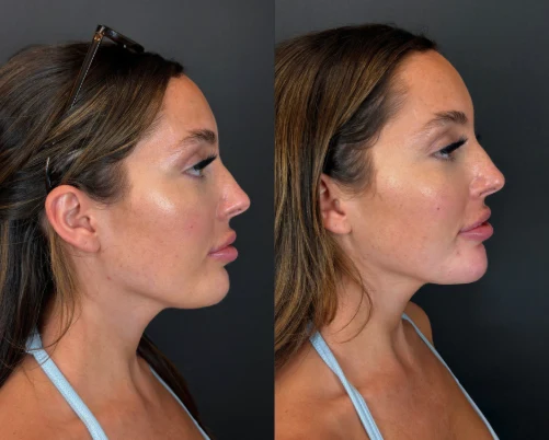 Dermal filler before and after, chin and jawline profile, side view, patient 4, enlarged