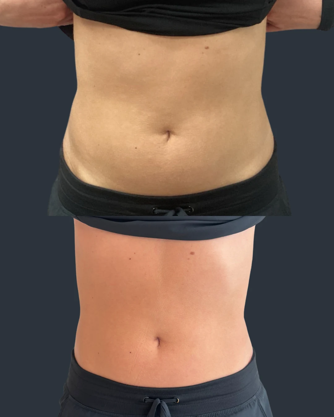 Emsculpt NEO before and after results, abdomen, front view, patient 1, enlarged