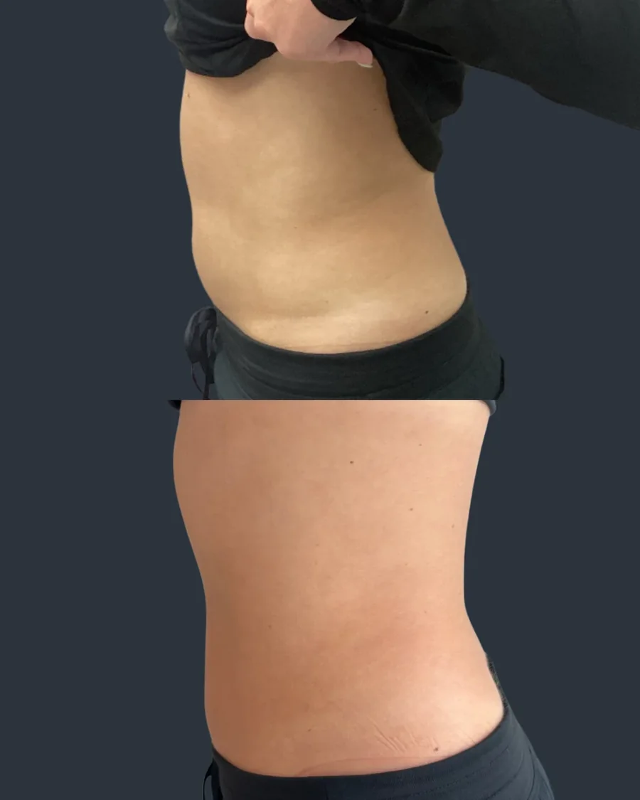Emsculpt NEO before and after results, abdomen and waist, left side view, patient 1