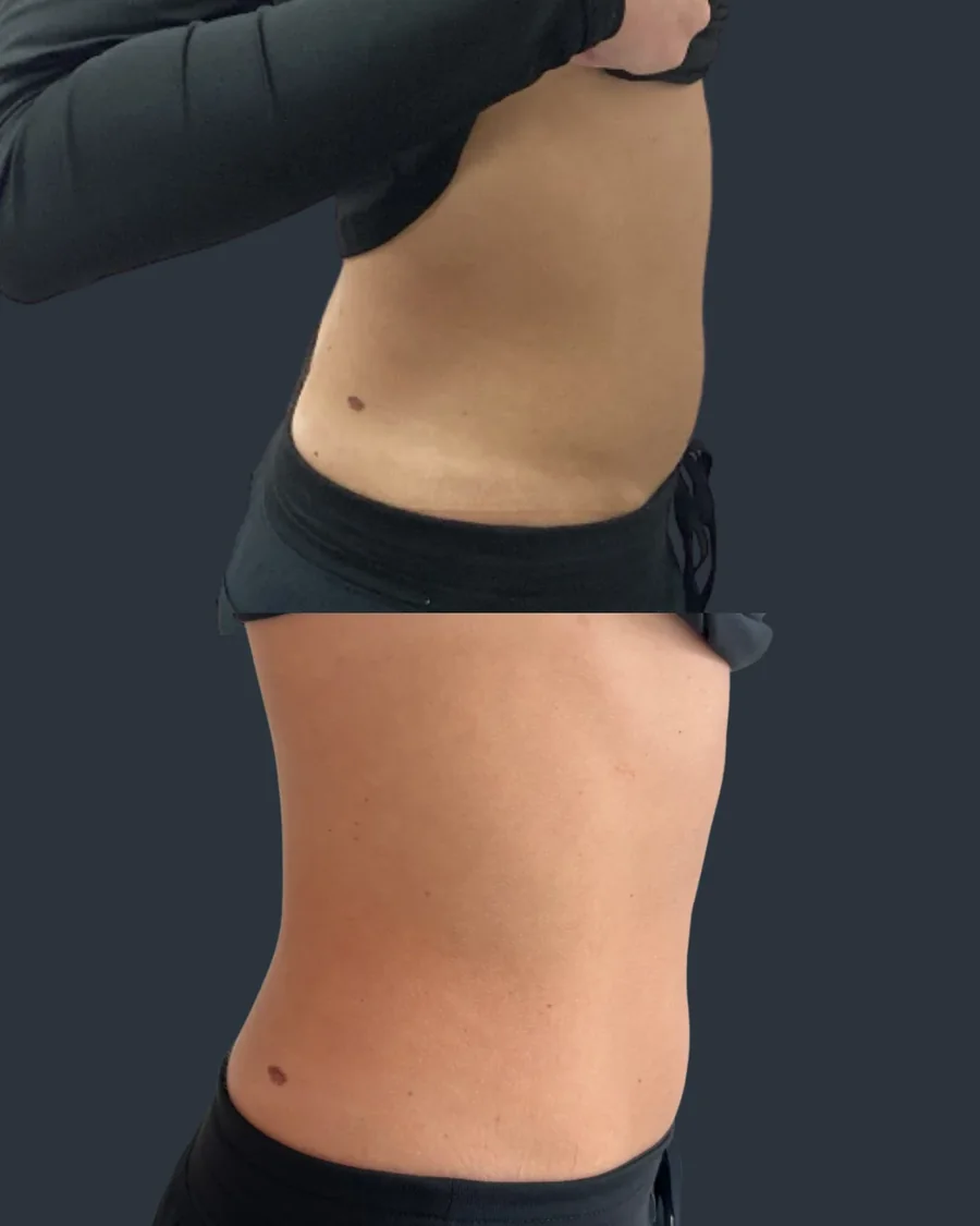 Emsculpt NEO before and after results, abdomen and waist, right side view, patient 1
