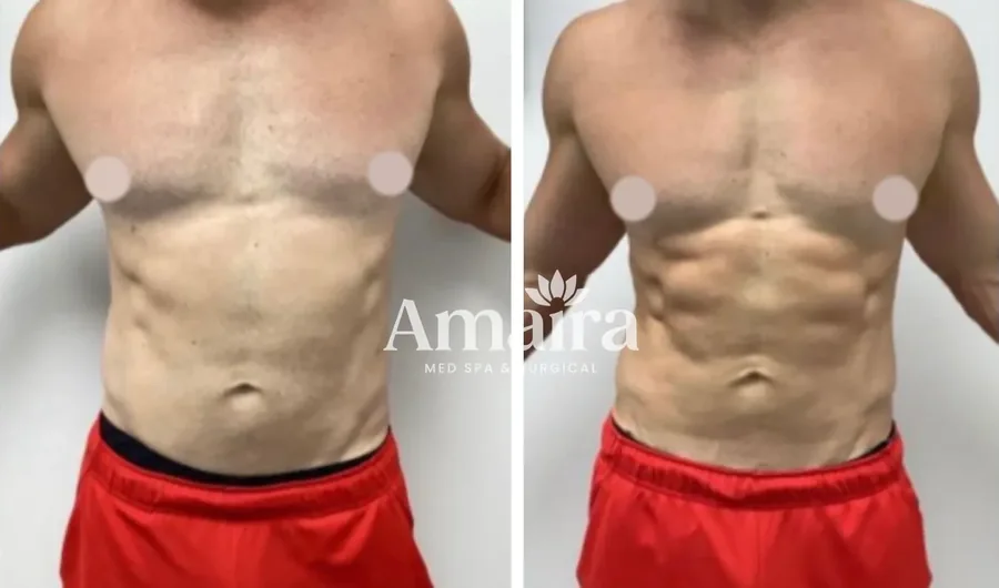 Emsculpt NEO before and after, men's chest and abs, front view, patient 2
