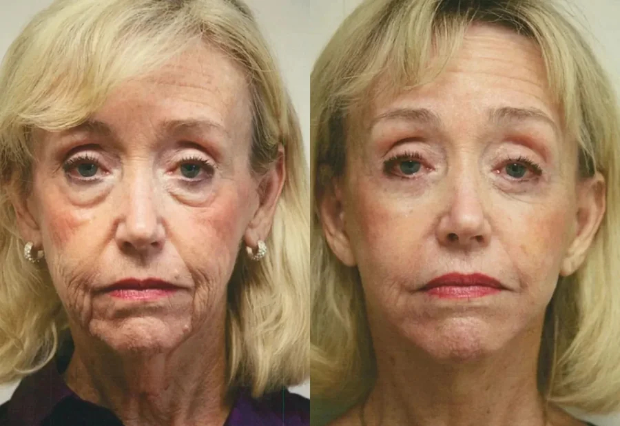 Facelift before and after