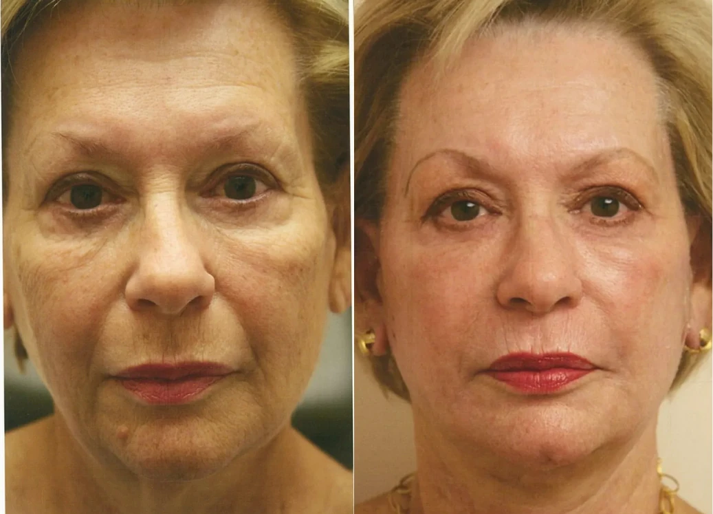 Facelift before and after