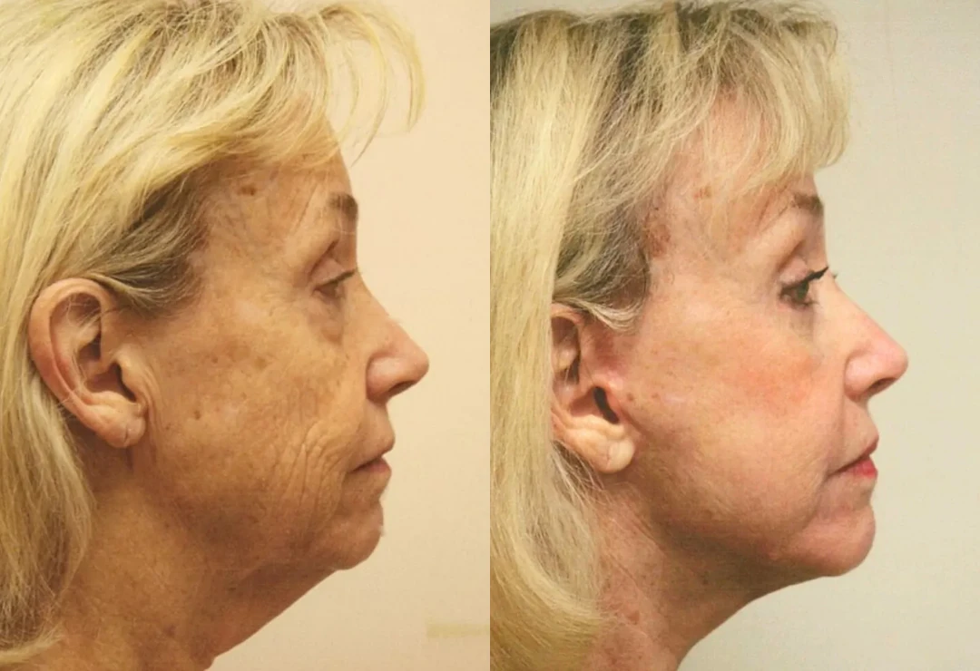 Facelift before and after
