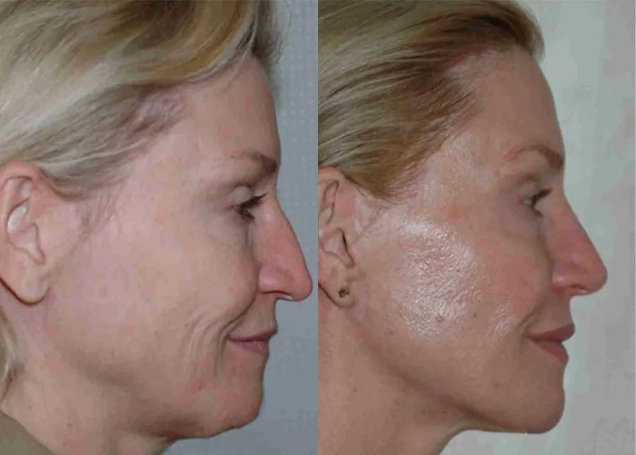 Facelift before and after