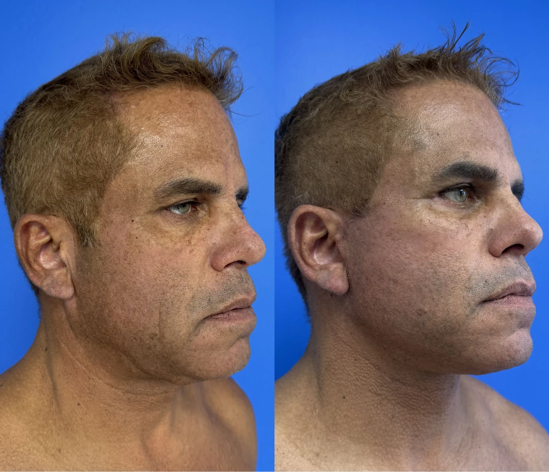 Facelift before and after