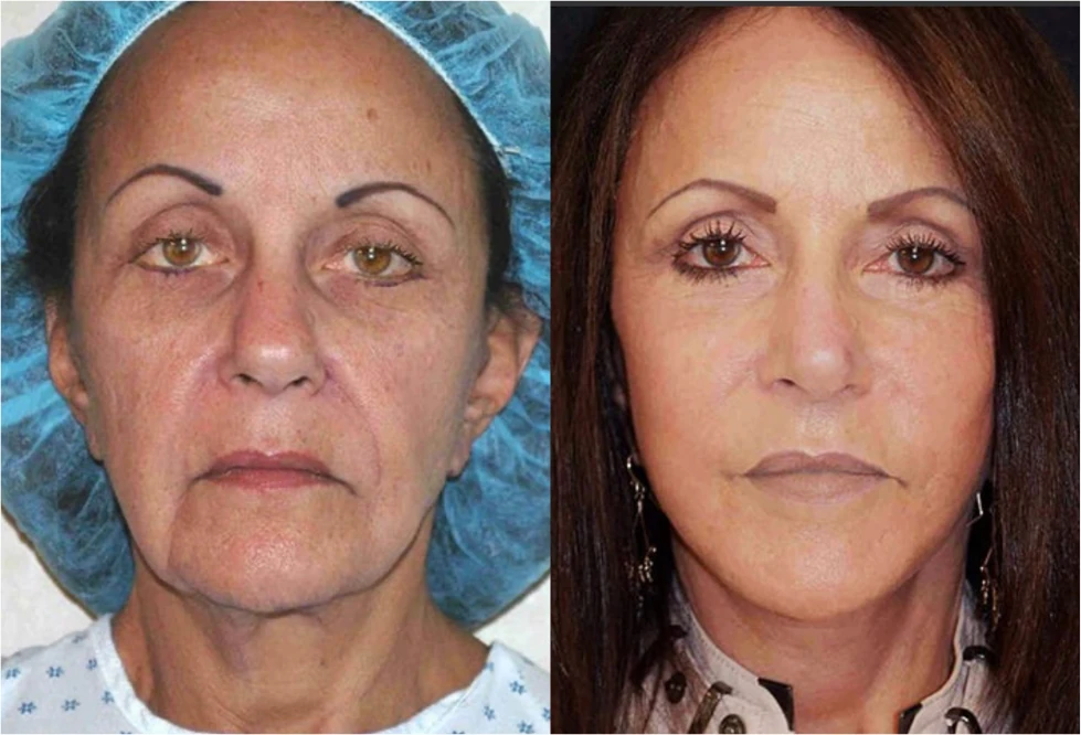 Facelift before and after