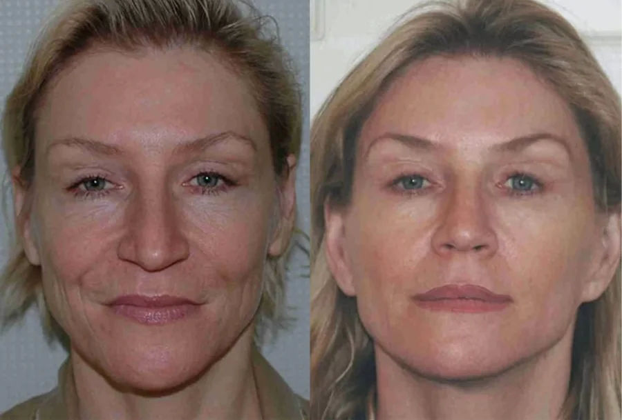 Facelift before and after