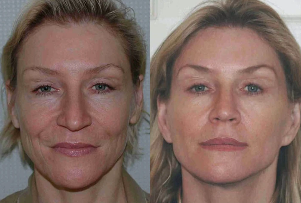 Facelift before and after