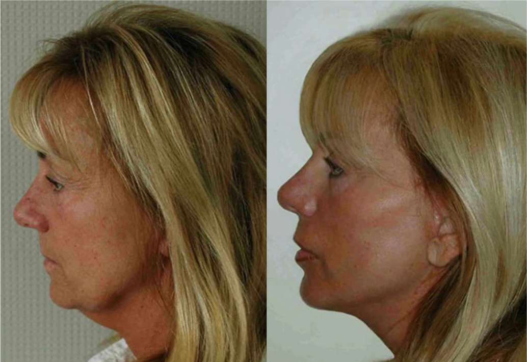 Facelift before and after