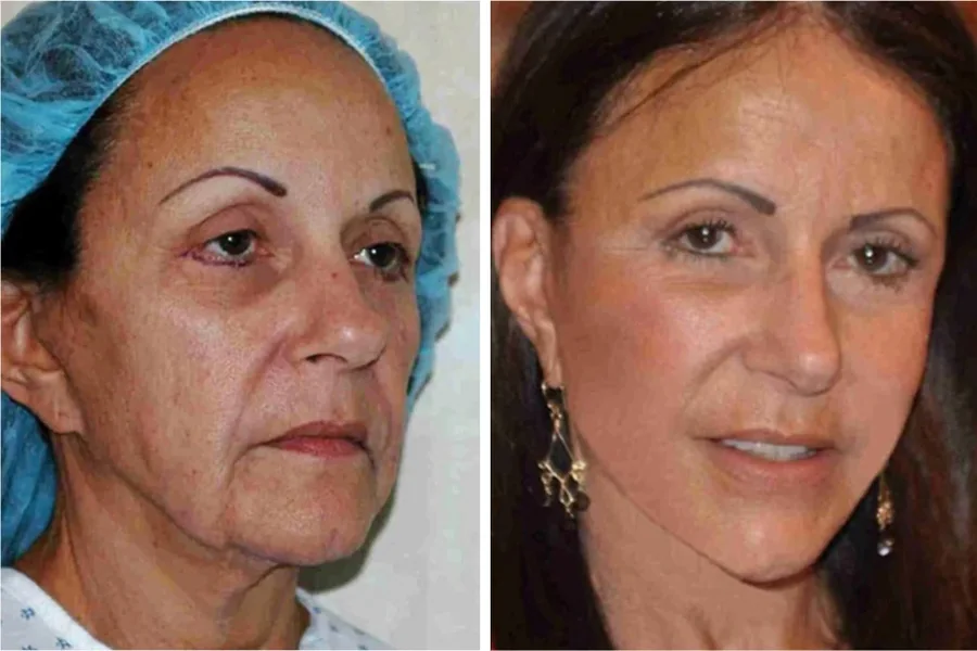 Facelift before and after