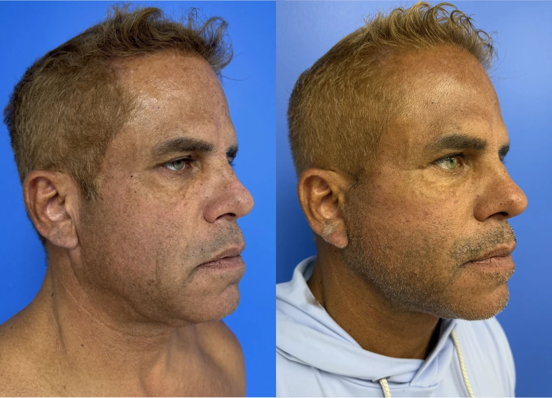 Facelift before and after