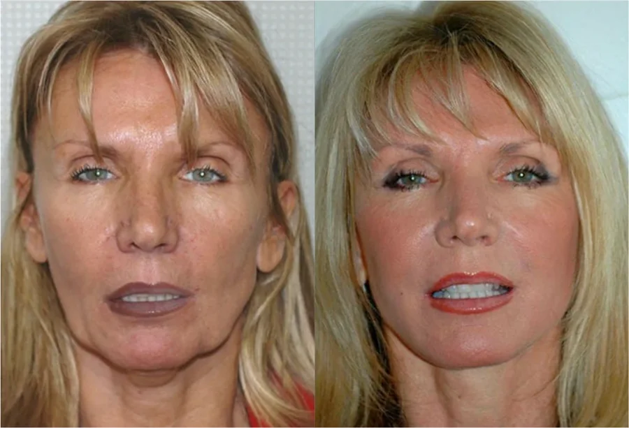 Facelift before and after