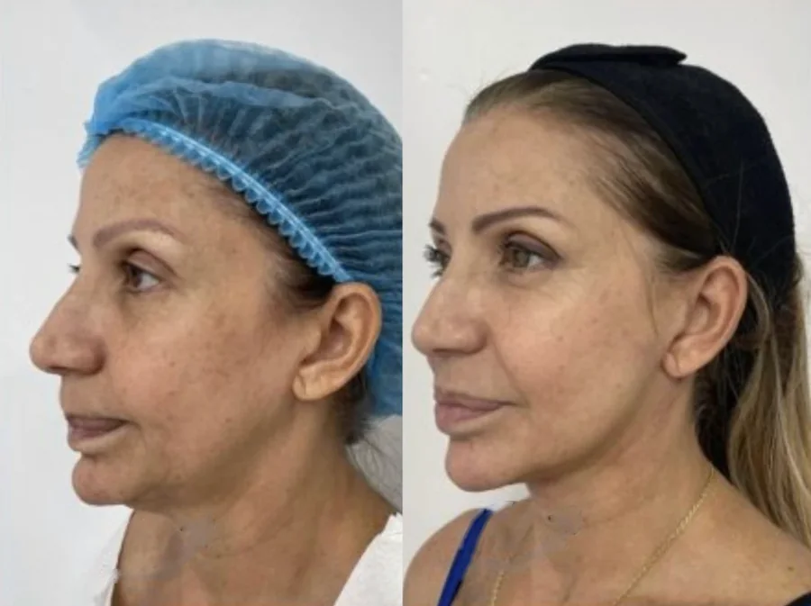 Facelift before and after