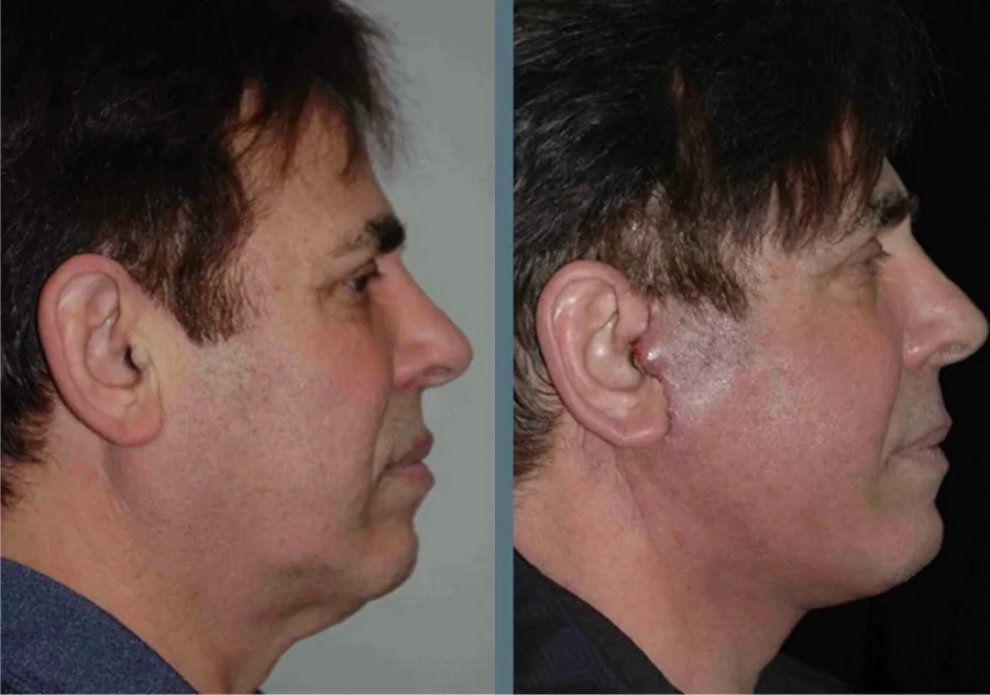 Facelift before and after