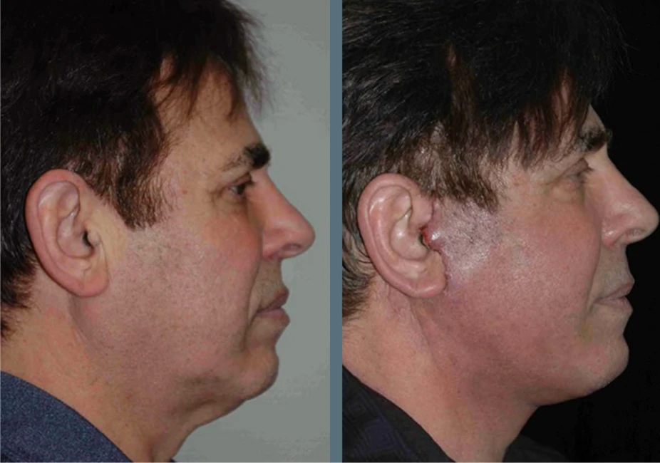 Facelift before and after
