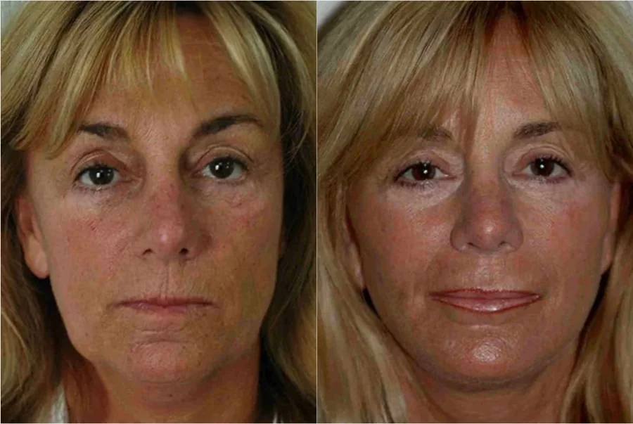 Facelift before and after