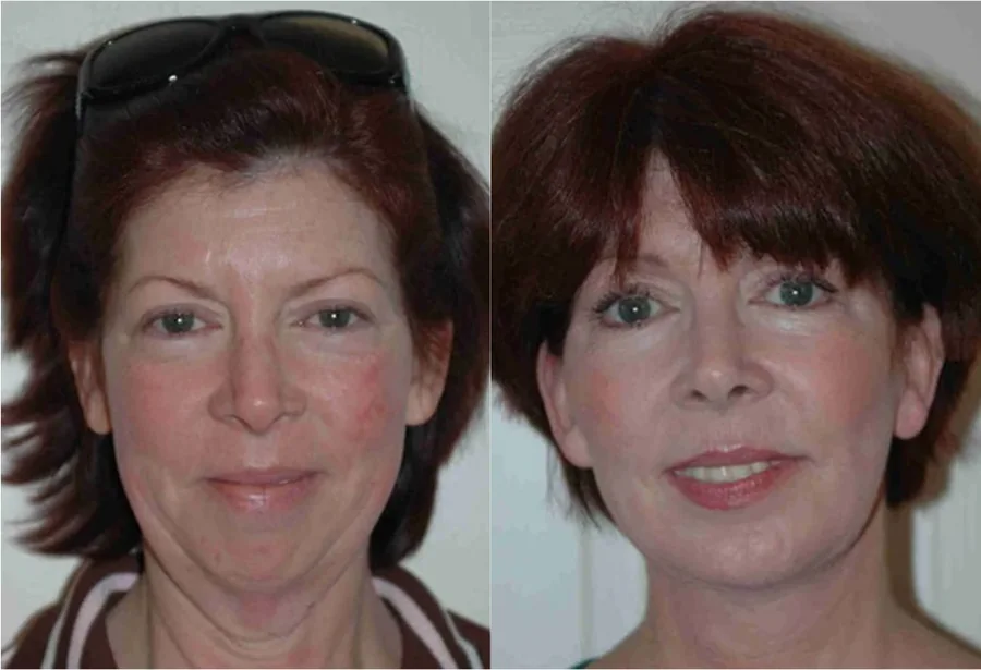 Facelift before and after