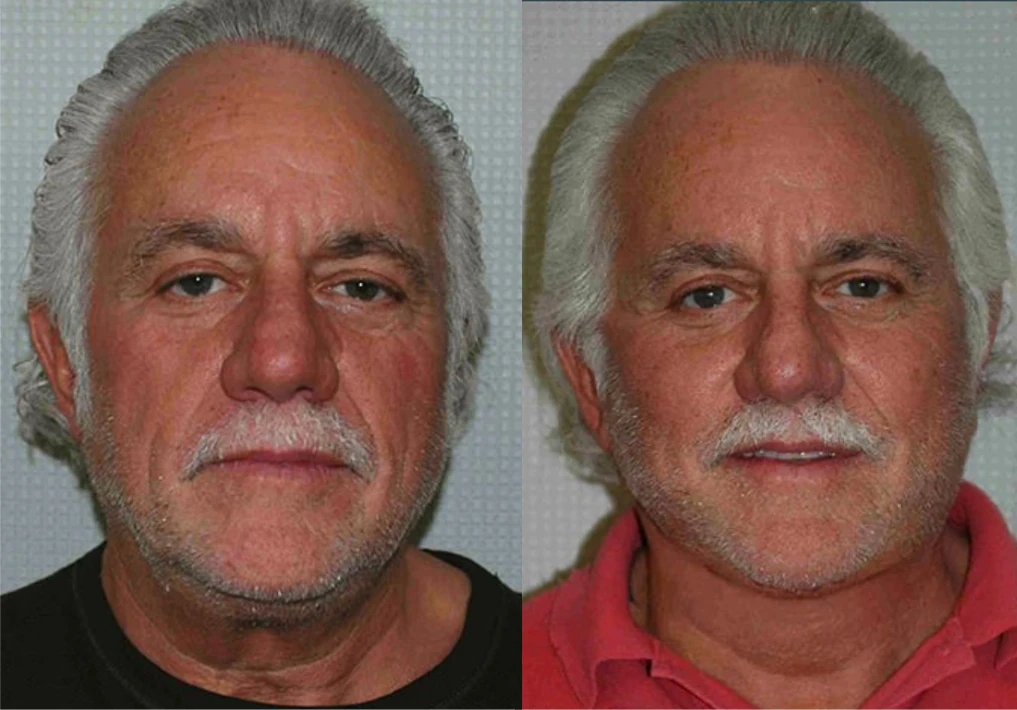 Facelift before and after
